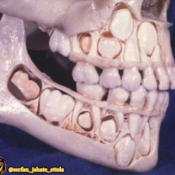 تصویر جمجمه بچه قبل از افتادن دندانهای شیری