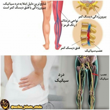 عصب سیاتیک بزرگترین عصب بدن است که از قسمت پایین کمر تا پاها ادامه دارد ،