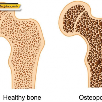 نشانه‌های پوکی استخوان