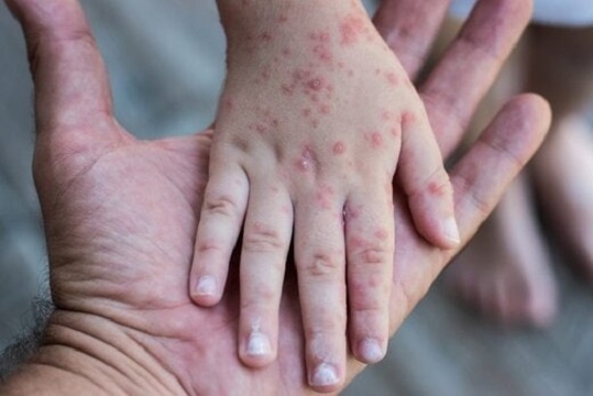 درخواست برای تکمیل واکسیناسیون سرخک کودکان