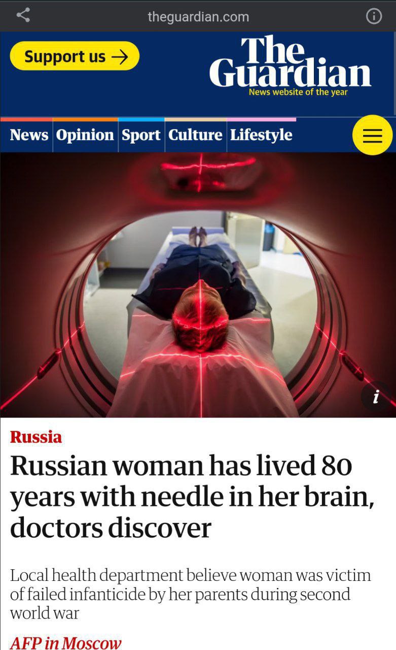 زن روس ٨٠ سال با سوزن فرو رفته در مغزش زندگی کرد